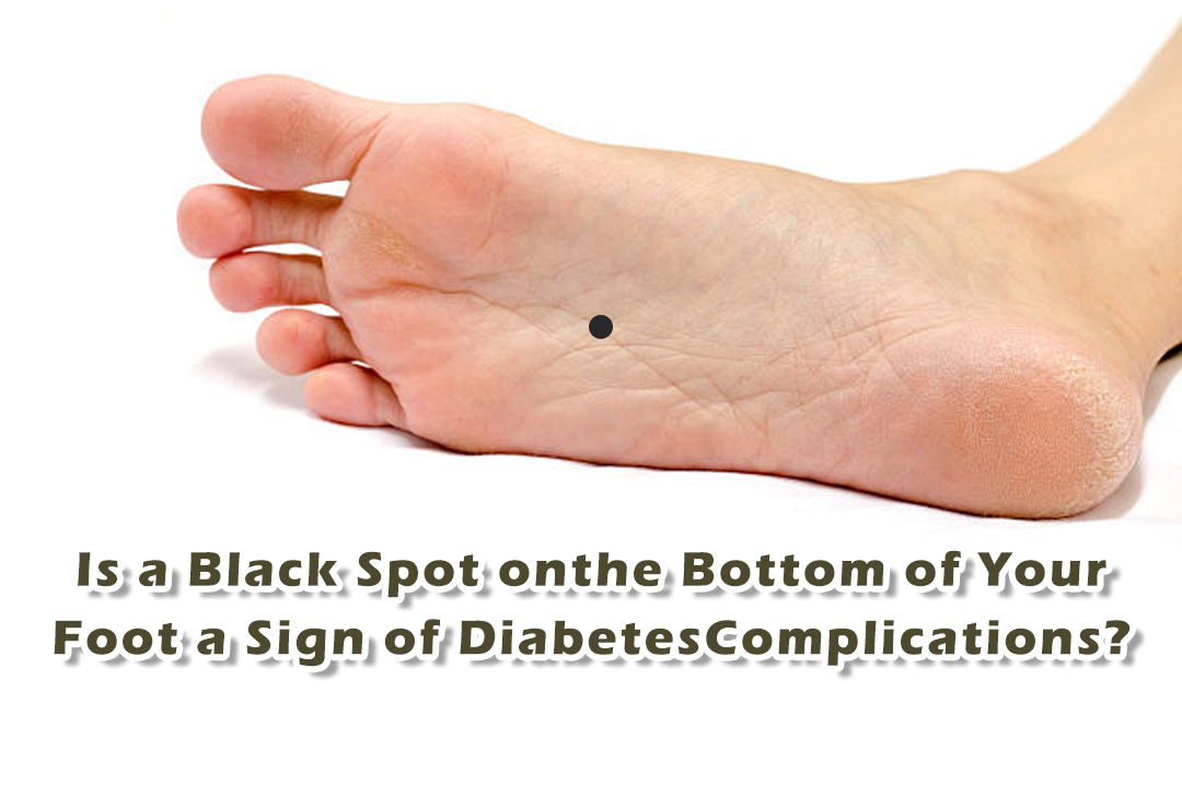 Is a Black Spot on the Bottom of Your Foot a Sign of Diabetes Complica